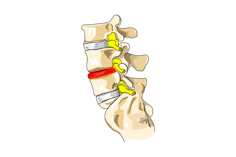 Degenerative Disc Disease