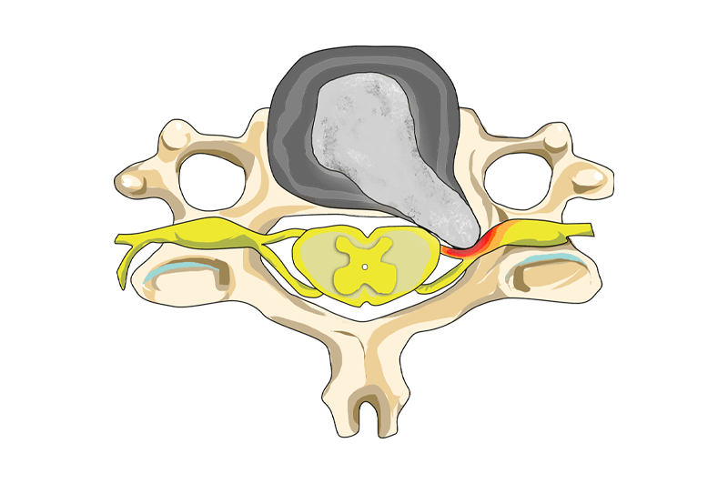 Nekhernia