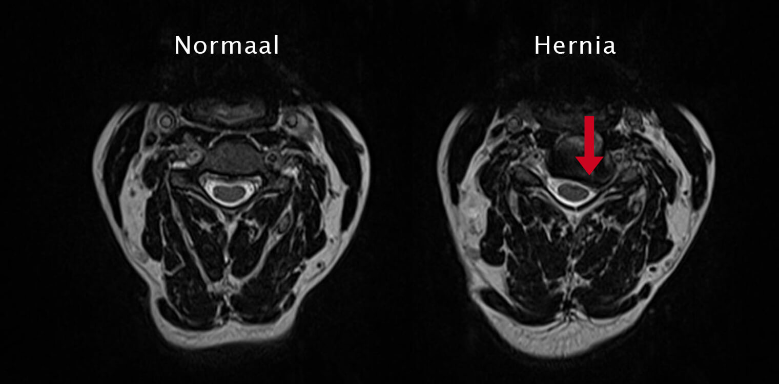 Diagnose van een nekhernia