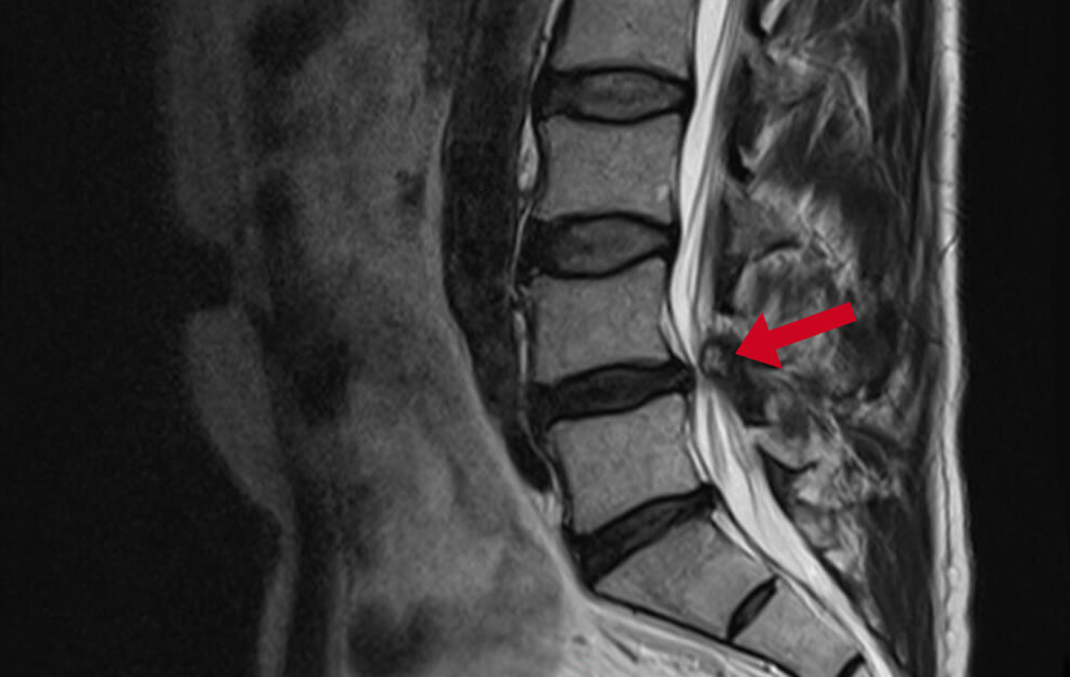 Diagnose van een kanaalvernauwing in de onderrug
